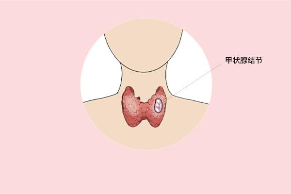 甲狀腺癌癥的主要癥狀表現(xiàn)有什么？為什么會得甲狀腺癌癥呢？