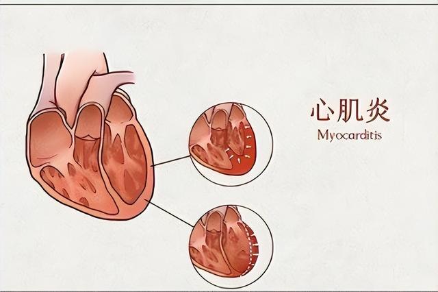 心肌炎的癥狀有哪些？心肌炎的主要變現(xiàn)癥狀有啥？